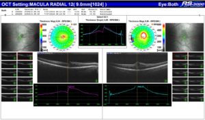 Macula Radial R + L2 - 7 July 2016